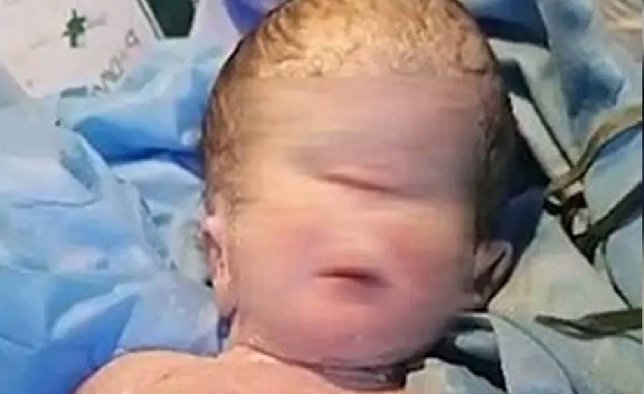 Birth of a Child with only one Eye in Iraq - Saudi-Expatriates.com