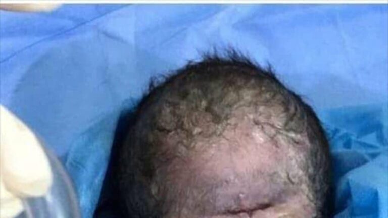 Birth of a Child with only one Eye in Iraq - Saudi-Expatriates.com